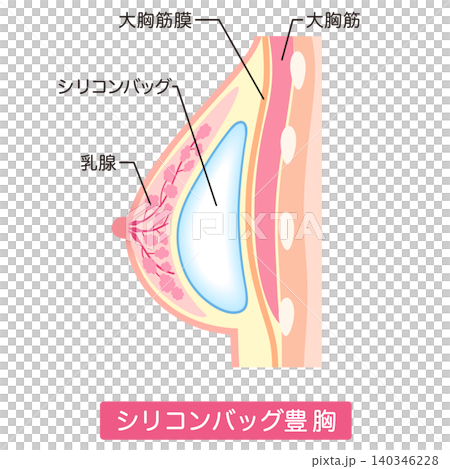シリコンバッグ豊胸 豊胸手術の種類 美容整形 胸 シリコンバッグ豊胸 豊胸手術の種類 美容整形 胸 140346228