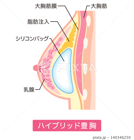 ハイブリッド豊胸 豊胸手術の種類 美容整形 胸 ハイブリッド豊胸 豊胸手術の種類 美容整形 胸 140346250