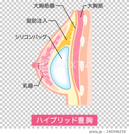 ハイブリッド豊胸 豊胸手術の種類 美容整形 胸 ハイブリッド豊胸 豊胸手術の種類 美容整形 胸 140346250