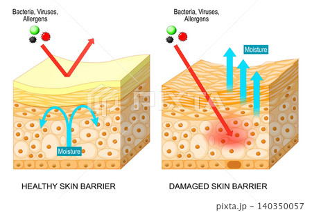 Skin barrier. Cross section of epidermis. Comparison of healthy and damaged skin barrier layers. Skin barrier. Cross section of epidermis. Comparison of healthy and damaged skin barrier layers. 140350057