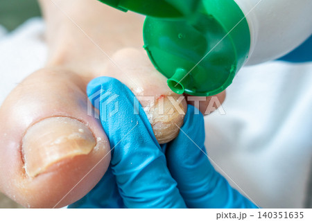 Applying Antiseptic to Injured Toe During Professional Pedicure Treatment 140351635
