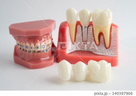 Dental implant, artificial tooth roots into jaw, root canal of dental treatment, gum disease, teeth model for dentist studying about dentistry. 140397908