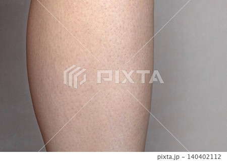 Skin on the leg after epilation, depilation. Close up Skin on the leg after epilation, depilation. Close up 140402112