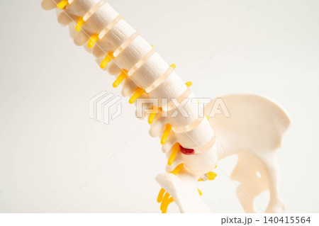 Spinal nerve and bone, Lumbar spine displaced herniated disc fragment, Model for treatment medical in the orthopedic department. 140415564
