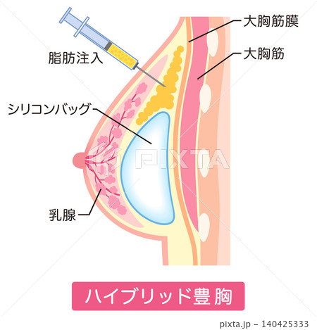 ハイブリッド豊胸 豊胸手術の種類 美容整形 胸 ハイブリッド豊胸 豊胸手術の種類 美容整形 胸 140425333