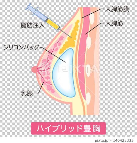 ハイブリッド豊胸 豊胸手術の種類 美容整形 胸 ハイブリッド豊胸 豊胸手術の種類 美容整形 胸 140425333