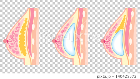隆乳手術類型;整形手術;乳房 隆乳手術類型;整形手術;乳房 140425372