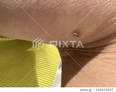 マダニに吸血された人間の膝の裏側 春夏の繁みはマダニに要注意 マダニに吸血された人間の膝の裏側 春夏の繁みはマダニに要注意 140425937