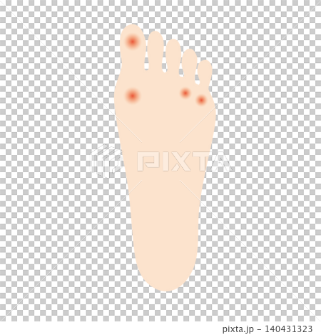 An illustration of a callus on the sole of a foot. 140431323