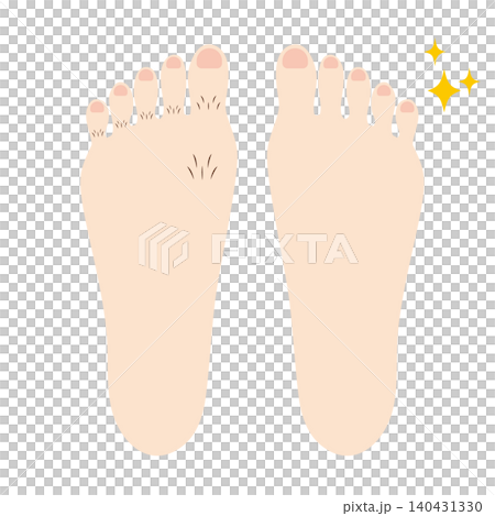 腳趾毛髮明顯增加的前後對比照片。 140431330