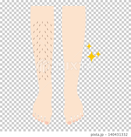 Legs before and after hair removal Legs before and after hair removal 140431332