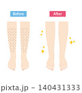脱毛前の脚と脱毛後の脚　ビフォーアフター 140431333