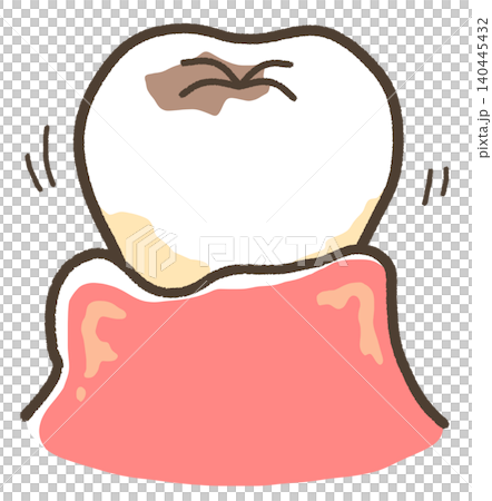 An illustration of teeth that are loose due to cavities and periodontal disease. An illustration of teeth that are loose due to cavities and periodontal disease. 140445432