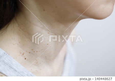 皮膚の悩み　イボのある女性の首まわり 140448627