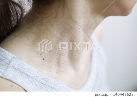 皮膚の悩み　イボのある女性の首まわり 140448628