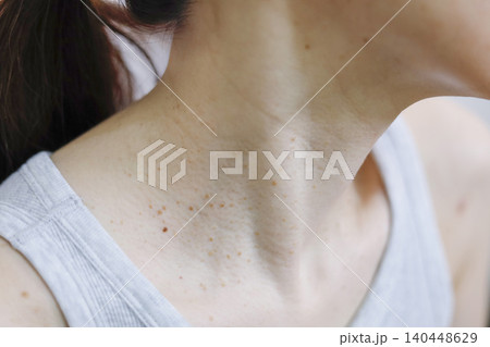 皮膚の悩み イボのある女性の首まわり 皮膚の悩み イボのある女性の首まわり 140448629