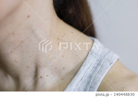 皮膚の悩み　イボのある女性の首まわり 140448630