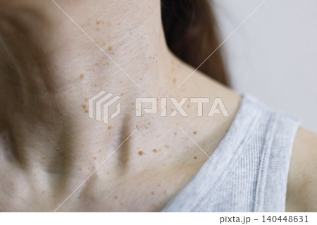 皮膚の悩み　イボのある女性の首まわり 140448631