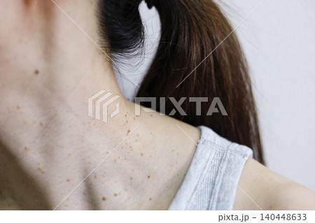 皮膚の悩み　イボのある女性の首まわり 140448633