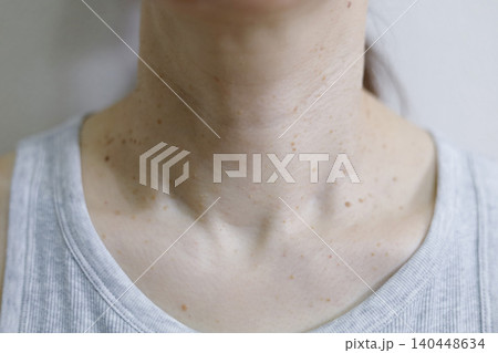 皮膚の悩み　イボのある女性の首まわり 140448634
