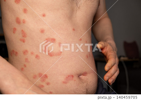 Individual displays visible patches of red, itchy psoriasis on the torso while seated indoors, highlighting the impact of this skin condition. 140459705