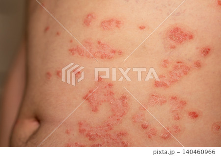 Patches of psoriasis visible on the skins surface show redness, scale, and itchiness, indicating a chronic immune condition affecting the skin. Patches of psoriasis visible on the skins surface show redness, scale, and itchiness, indicating a chronic immune condition affecting the skin. 140460966