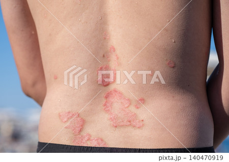 Back of an individual displays patches of psoriasis under bright sunlight, highlighting the skin condition in an outdoor setting. 140470919