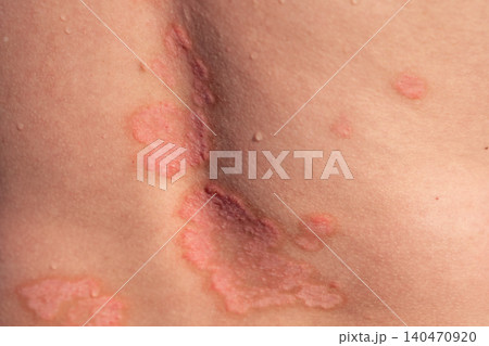 Close-up view of skin affected by psoriasis, showing red patches and flaking, highlighting the severity of the skin condition on the back area 140470920