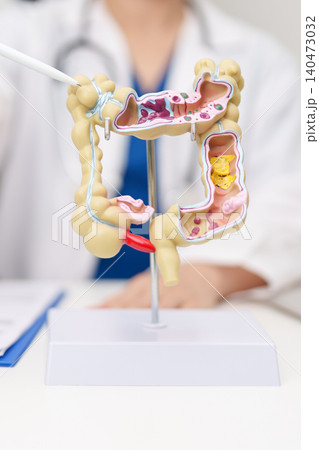 Doctor with human Colon anatomy model. Colonic disease, Large Intestine, Colorectal cancer, Ulcerative colitis, Diverticulitis, Irritable bowel syndrome, Digestive system and Healthcare concept Doctor with human Colon anatomy model. Colonic disease, Large Intestine, Colorectal cancer, Ulcerative colitis, Diverticulitis, Irritable bowel syndrome, Digestive system and Healthcare concept 140473032