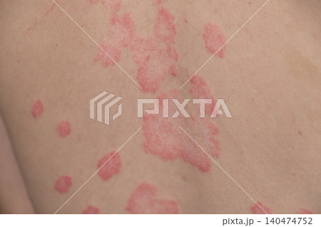 Psoriasis Vulgaris, skin patches are typically red, itchy, and scaly. Papules of chronic psoriasis vulgaris on male hand, back and body. Genetic immune disease. Detail of psoriatic skin disease Psoriasis Vulgaris, skin patches are typically red, itchy, and scaly. Papules of chronic psoriasis vulgaris on male hand, back and body. Genetic immune disease. Detail of psoriatic skin disease 140474752