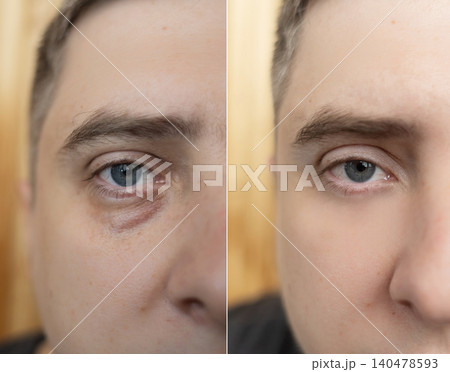 Before and after blepharoplasty or cosmetic treatment. Close up of man face showing reduction of eye bags, festoons, and dark circles under eyes. Male skin rejuvenation concept. 140478593