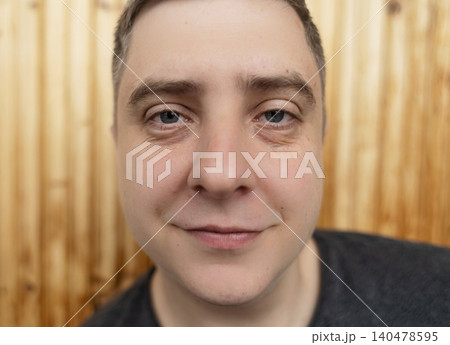 Close up portrait of a young man with dark circles and bags under eyes. Male face before blepharoplasty surgery, showing tired look, swelling and skin aging signs. Close up portrait of a young man with dark circles and bags under eyes. Male face before blepharoplasty surgery, showing tired look, swelling and skin aging signs. 140478595