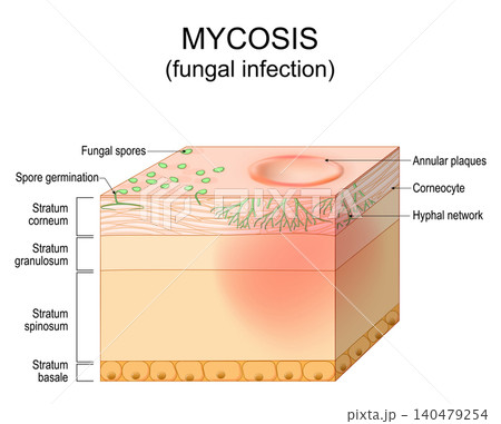 Skin Fungal infection. Mycosis. Skin disease caused by fungi. Dermatophyte, hyphae and spore invasion skin layer. Dermatology. Skin Fungal infection. Mycosis. Skin disease caused by fungi. Dermatophyte, hyphae and spore invasion skin layer. Dermatology. 140479254