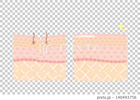 Skin cross-section diagrams: Before and after photos of wrinkles and sagging skin. Skin cross-section diagrams: Before and after photos of wrinkles and sagging skin. 140493756