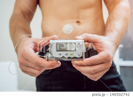 Diabetic man with an insulin pump connected in his abdomen and holding the insulin pump at his hands. Diabetic man with an insulin pump connected in his abdomen and holding the insulin pump at his hands. 140502742