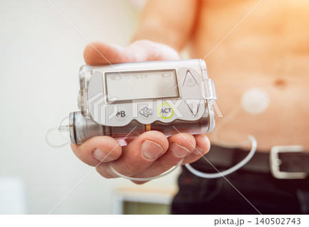 Diabetic man with an insulin pump connected in his abdomen and holding the insulin pump at his hands. 140502743