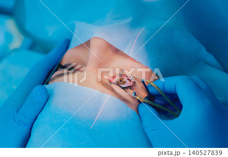 Laser vision correction. A patient and team of surgeons in the operating room during ophthalmic surgery. Eyelid speculum. Lasik treatment. Laser vision correction. A patient and team of surgeons in the operating room during ophthalmic surgery. Eyelid speculum. Lasik treatment. 140527839