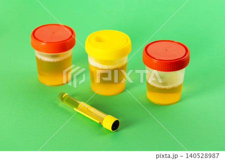 A test tube with urine against a green background, next to a three-glass urine sample. Concept for urine testing for infections causing pyelonephritis, urethritis, and cystitis, close-up 140528987