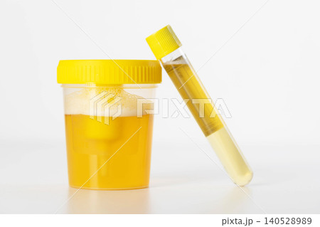 A urine test tube on a white background for bacterial infections that cause inflammation, cystitis, and urethritis. Urine tests, close-up A urine test tube on a white background for bacterial infections that cause inflammation, cystitis, and urethritis. Urine tests, close-up 140528989