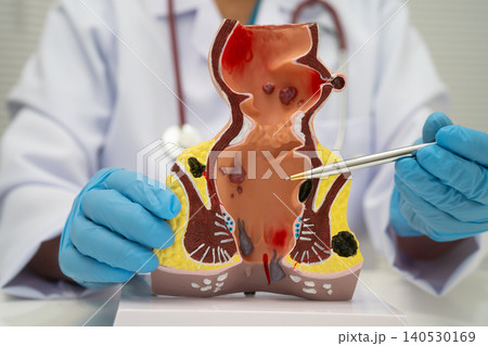 Asian doctor with rectum and hemorrhoid human anatomy model at hospital, inflamed vascular structure. 140530169