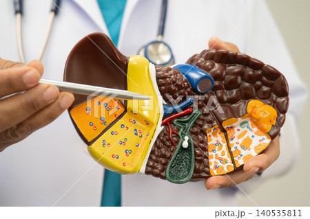 Cirrhosis, Liver cancer, fatty liver, Asian doctor with liver human model. Cirrhosis, Liver cancer, fatty liver, Asian doctor with liver human model. 140535811