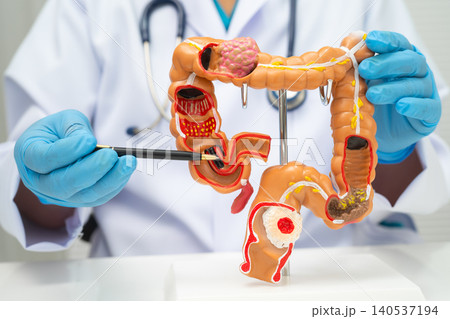 Colorectal cancer, doctor holding intestine colon human anatomy model. 140537194