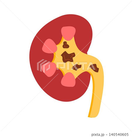 kidney stones indside renal calyx, renal pelvis and ureter represent pathology of urolithiasis kidney stones indside renal calyx, renal pelvis and ureter represent pathology of urolithiasis 140540605