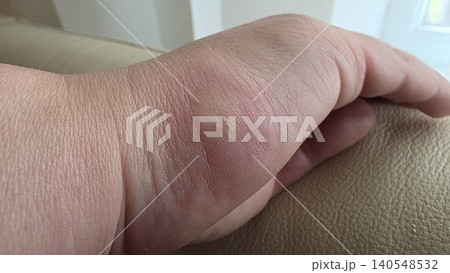 Close up of swollen caucasian human hand with red skin and insect bite blister resting on beige leather sofa background, concept of healthcare and allergic reaction 140548532