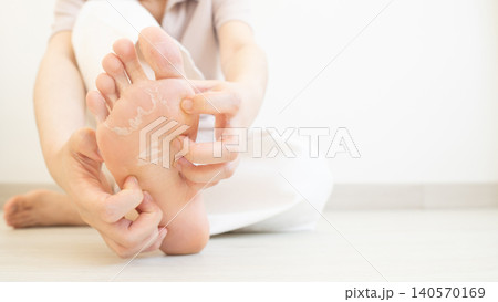Woman scratching itchy feet that are peeling and cracked. Cause of itchy include athlete's foot (fungal infection), dermatitis (eczema), dry skin, dehydration or sweaty feet. Health care concept. 140570169