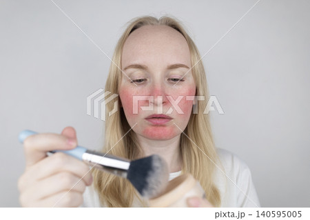 Blonde woman applying face powder to conceal skin redness, rosacea symptoms, or sunburn. Girl covering up damaged, irritated skin with cosmetic makeup brush. 140595005