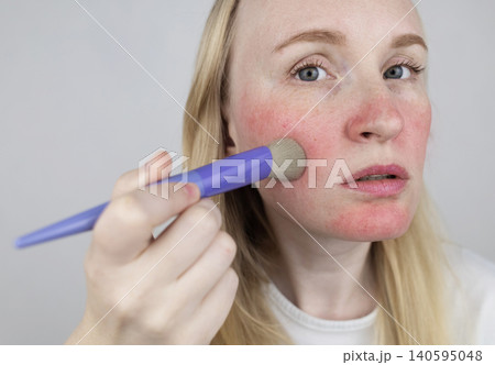 Blonde woman applying face powder to conceal skin redness, rosacea symptoms, or sunburn. Girl covering up damaged, irritated skin with cosmetic makeup brush. Blonde woman applying face powder to conceal skin redness, rosacea symptoms, or sunburn. Girl covering up damaged, irritated skin with cosmetic makeup brush. 140595048