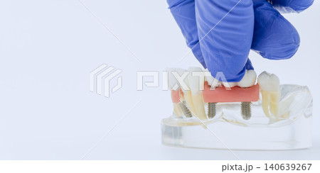 Gloved Hand Installing Implant Supported Dental Bridge on Jaw Model Gloved Hand Installing Implant Supported Dental Bridge on Jaw Model 140639267