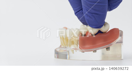 Gloved Hand Placing Three-Unit Dental Bridge on Implants Gloved Hand Placing Three-Unit Dental Bridge on Implants 140639272