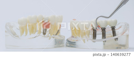 Dental Probe Inspecting Implant Supported Bridge on Jaw Models Dental Probe Inspecting Implant Supported Bridge on Jaw Models 140639277